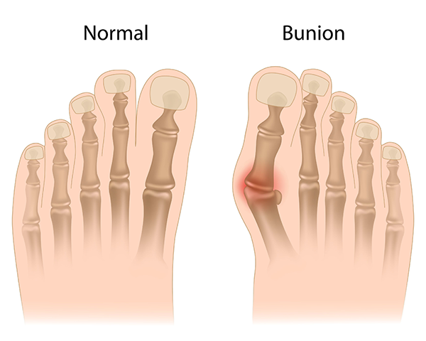 The image features a medical illustration of a human foot with an annotated area labeled Bunion, showing the normal and abnormal conditions for comparison.