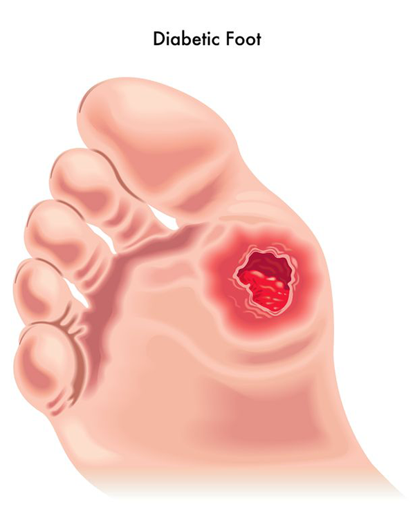 The image is a medical illustration showing the foot with a red spot, indicating a diabetic foot condition.