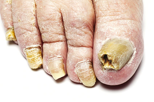 The image shows a close-up of a human foot with a toe nail that appears to be in the process of being removed or treated, and there are visible signs of infection or irritation on the skin around the toes.